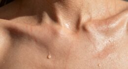 skin damage from sweat